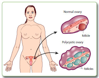 PCOS